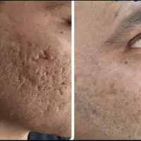 درمان تخصصی جای جوش اسکار و لک