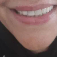 ساخت دندان مصنوعی فلیپر (تک واحدی و دو واحدی)|خدمات آرایشگری و زیبایی|آمل, |دیوار