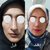 عمل زیبایی بینی|خدمات آرایشگری و زیبایی|زنجان, |دیوار