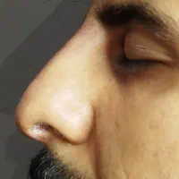 اصلاح فرم بینی بدون جراحی|خدمات آرایشگری و زیبایی|رشت, بلوار گیلان|دیوار