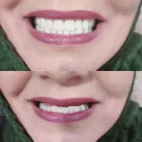 پروتز دندان (دندان مصنوعی)|خدمات آرایشگری و زیبایی|تربت‌حیدریه, بازار|دیوار