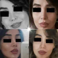 عمل بینی (پیکر تراشی تخصصی) لیپو لیفت پروتز سینه|خدمات آرایشگری و زیبایی|تهران, فلسطین (میدان انقلاب)|دیوار