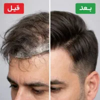 ترمیم تخصصی ((پروتز مو)) در سریعترین زمان ممکن