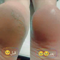 پدیکوریست خاص/ترک/پینه/قوزک|خدمات آرایشگری و زیبایی|قم, سالاریه|دیوار