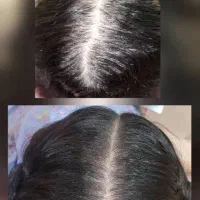 درمان ریزش مو