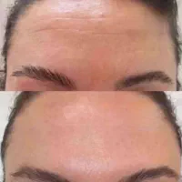 رفع چین و چروک با جدیدترین متد روز دنیا