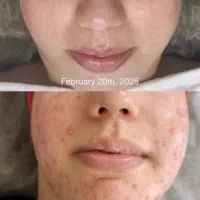 مدل جهت پاکسازی پوست درمان جوش،لک،آبرسانی|خدمات آرایشگری و زیبایی|آبادان, |دیوار