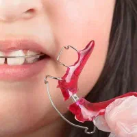 سیم پیچی( ارتودنسی)