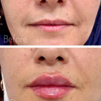 ژل بوتاکس لیزر لاغری مشاوره رایگان مطب دکتر فرخی