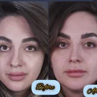 خدمات تخصصی فیلر و بوتاکس ومزوتراپی|خدمات آرایشگری و زیبایی|شاهینشهر, فردوسی|دیوار