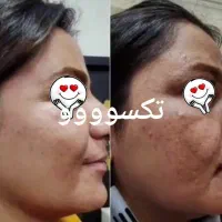 باتکسو زیبا شو اونم بدون عوارض وتضمینی|آرایشی، بهداشتی، درمانی|مشهد, شهرک ابوذر|دیوار