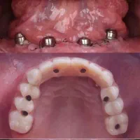 مرکز ایمپلنت و اوردنچر در ارومیه