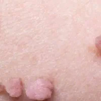 درمان ۱۰۰ درصدی زگیل تناسلی