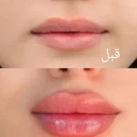 زیبایی تا عیدتخفیف ۵۰درصدی ژل بوتاکس درکلینیک