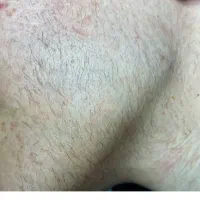 الکترولیز تنها روش قطعی از بین بردن هر نوع مو|خدمات آرایشگری و زیبایی|صدرا-فارس, فاز ۱|دیوار