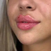 ژل و بوتاکس