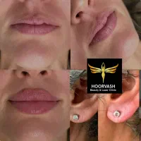 بوتاکس فیلر مزو نخ پی آر پی چربی جوانسازی بدون عمل|خدمات آرایشگری و زیبایی|کرج, گلشهر|دیوار