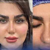 جشنواره عمل بینی ، لیفت شقیقه، اندسکوپیک، مید فیس