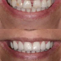 زیبایی دندان