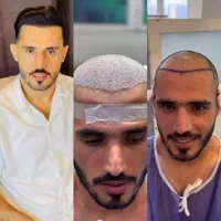 کاشت مو اقساطی باضمانت نامه کتبی مادام‌العمر|خدمات آرایشگری و زیبایی|یزد, |دیوار