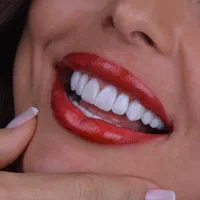خدمات زیبایی دندان(کامپوزیت، لمینیت، بلیچینگ)