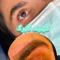 ریموو تتو ابرو و بدن(گلبرگ)