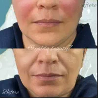 تزریق ژل و بوتاکس|خدمات آرایشگری و زیبایی|بابل, |دیوار