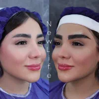 کاشت ابروبدون ظاهر مصنوعی به صورت تاربه تار