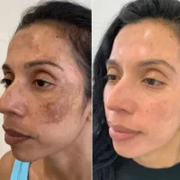 کرم بیوممتیک ضدلک (اصل) دارای ضمانت نامه