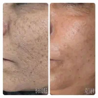 جشنواره درمان تضمینی کک و مک/ زگیل / فقط در 1 جلسه|خدمات آرایشگری و زیبایی|اصفهان, باتون|دیوار