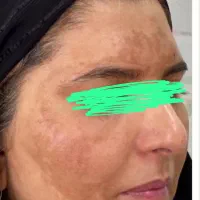 کرم ضد لک تخصصی|آرایشی، بهداشتی، درمانی|ایرانشهر, |دیوار