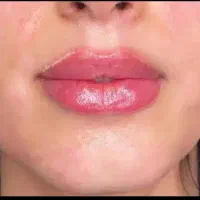 فیلر لب وگونه وخط خنده ‌فقط فقط ...