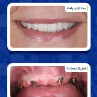 ایمپلنت کره ای و سوئیسی یک روزه