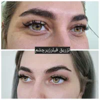 بوتاکس ژل نخ چالگونه مزو انزیم فیلر|خدمات آرایشگری و زیبایی|تبریز, |دیوار