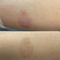 لیزر موهای زایدپاک کردن تاتورنگی وتیره وکربن تراپی|خدمات آرایشگری و زیبایی|همدان, |دیوار