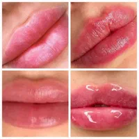 تزریق ژل،بوتاکس،چربی،لیفت صورت لیزرمو،درمطب زیبایی