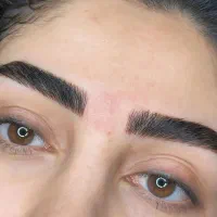 میکروبلیدینگ و فیبروز ابرو