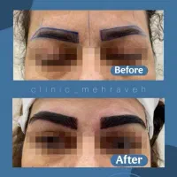 کاشت ویژه و تخصصی مو و ابرو|خدمات آرایشگری و زیبایی|تهران, دزاشیب|دیوار