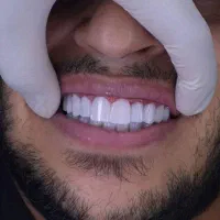 کامپوزیت دندان و کشیدن دندان|خدمات آرایشگری و زیبایی|کرج, حیدرآباد|دیوار