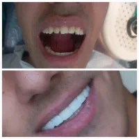 کامپوزیت دندان|خدمات آرایشگری و زیبایی|یاسوج, |دیوار