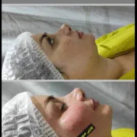 لیزرتاتوبوتاکس بیوفیلرالکترولیزخال لیزرموی پرسینگ|خدمات زیبایی و سلامت|اهواز, کیانپارس |دیوار
