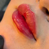 ژل و بوتاکس