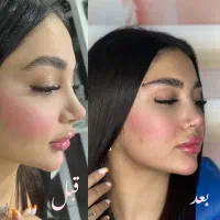 تزریق ژل فیلر بوتاکس و نخ لیفت با قیمت باورنکردنی|خدمات آرایشگری و زیبایی|رشت, گلسار|دیوار