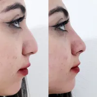 اصلاح قوز و افتادگی بینی بدون جراحی در مطب20%تخفیف|خدمات آرایشگری و زیبایی|شاهین‌شهر, فردوسی|دیوار