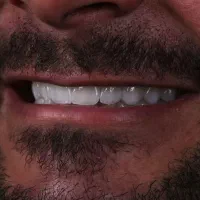 کامپوزیت لمینت ایمپلنت عصبکشی روکش دندانپزشکی|خدمات آرایشگری و زیبایی|تهران, سعادت‌آباد|دیوار