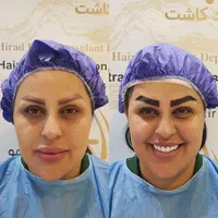 کاشت مو،کاشت ابرو،کاشت ریش با شرایط استثنایی|خدمات آرایشگری و زیبایی|تهران, دردشت|دیوار