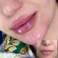 آموزش خصوصی ژل لب و  پیرسینگ