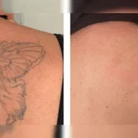 پاک کردن تتو .لیزر.پاککردن خالکوبی .ریموو تتو.prp|خدمات آرایشگری و زیبایی|اصفهان, خلجا|دیوار