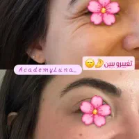 فیلر و بوتاکس