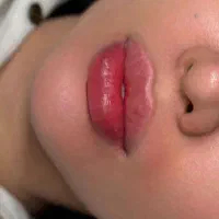 تخفیف ۳۰ درصدی اموزش وانجام خدمات ژل بوتاکس